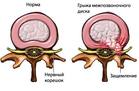 Грыжи межпозвоночного диска Грыжи межпозвоночного диска